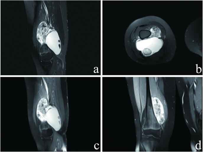 Miopericitoma del muslo en RM