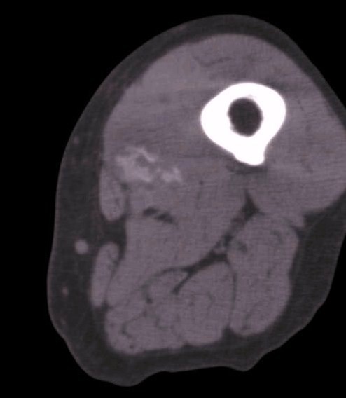Miositis osificante del muslo en TC