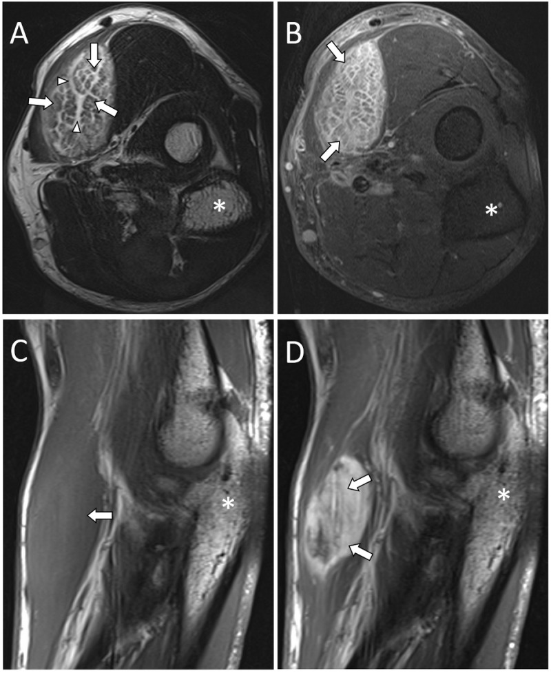 Miositis proliferativa del antebrazo en RM