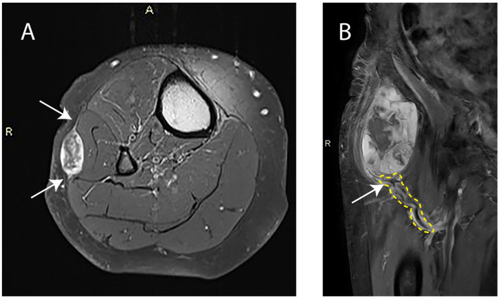 Resonancia en dos paneles: mixofibrosarcoma superficial de pierna con signo de la cola y, en otro caso, mixofibrosarcoma profundo del muslo con su pedículo vascular.