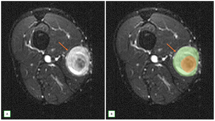 Resonancia de un neurofibroma con el signo de la diana en el muslo.