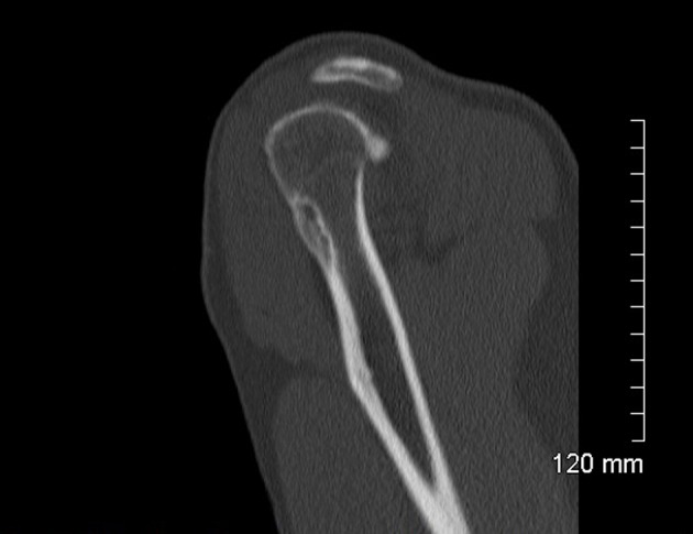 TAC de un osteoblastoma en el húmero.