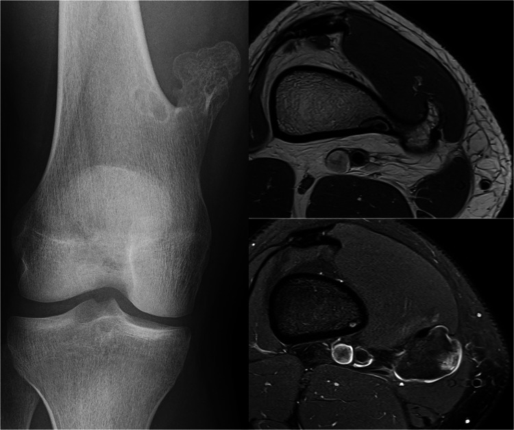 Radiografía y resonancia de osteocondroma pediculado de fémur distal.