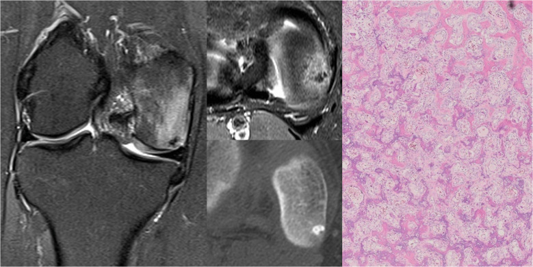 Resonancia, TAC e histología de osteoma osteoide del cóndilo femoral.