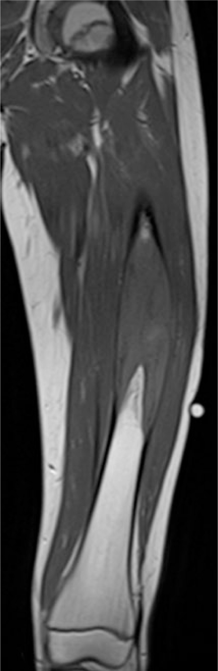 Osteosarcoma central de bajo grado del fémur en RM