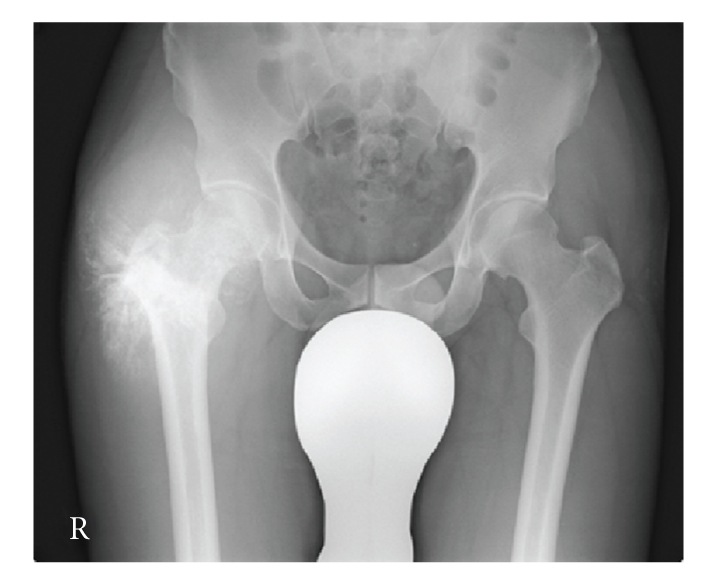 Osteosarcoma extraesquelético del muslo en radiografía