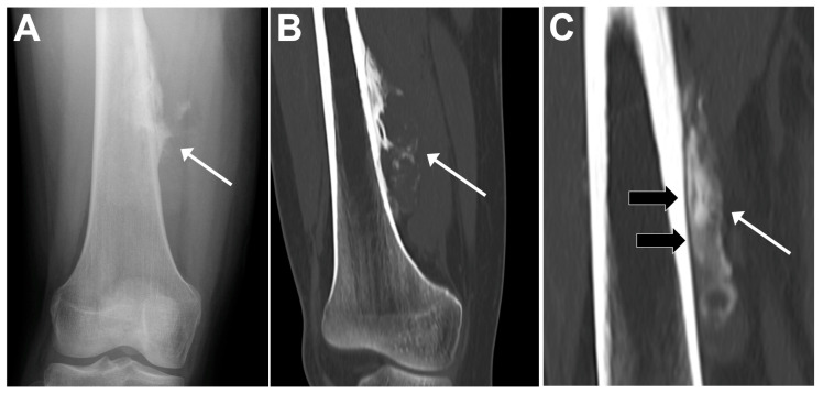 Radiografía y TAC de un osteosarcoma parostal en la diáfisis distal del fémur.