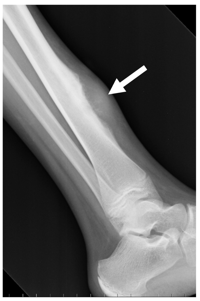Radiografía lateral de tobillo de un osteosarcoma periostal de la tibia distal.