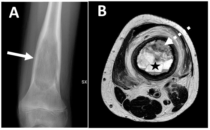 Radiografía y resonancia de un osteosarcoma telangiectásico del fémur distal.