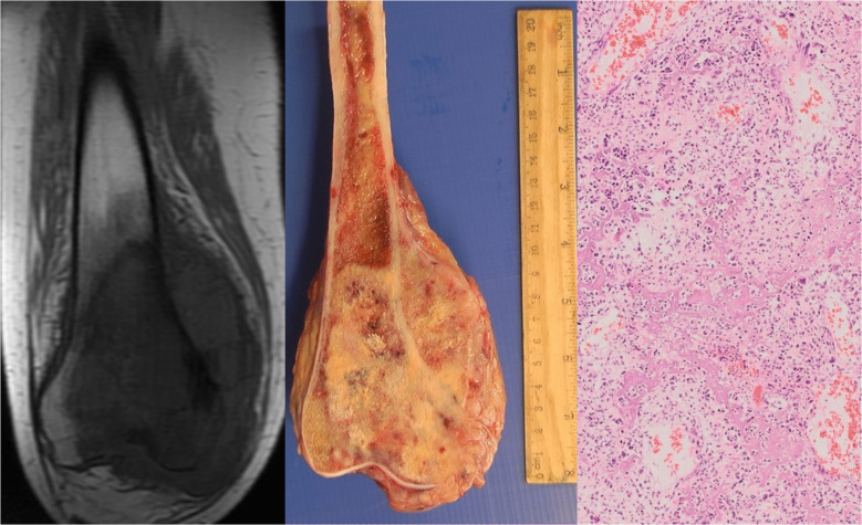Resonancia, pieza quirúrgica e histología de un osteosarcoma central convencional del fémur distal.