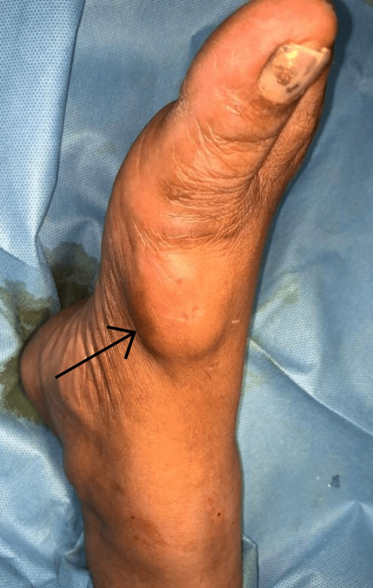 Foto clínica del pie con un perineurioma de partes blandas.
