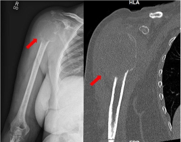 Plasmocitoma óseo del húmero proximal en radiografía y TC