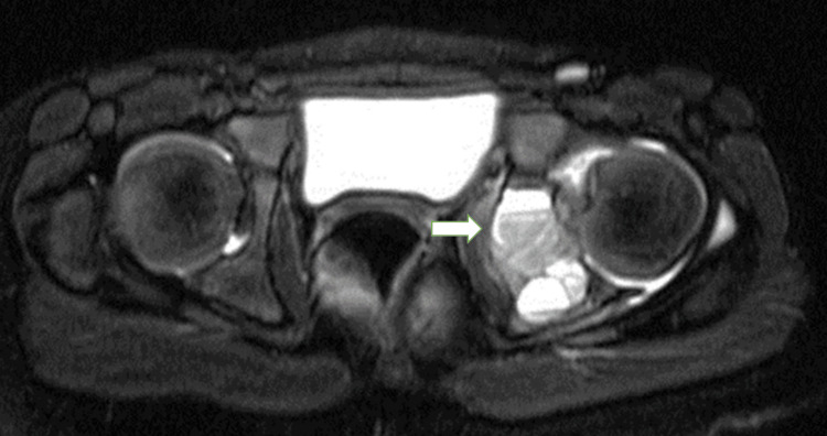 Resonancia axial de pelvis con un quiste óseo aneurismático y un nivel líquido-líquido.