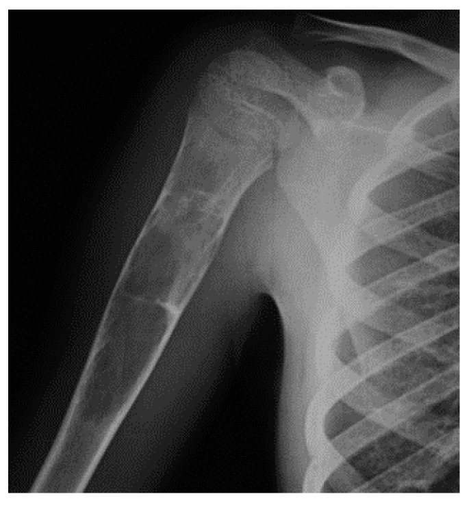 Radiografía del hombro con un quiste óseo simple en el húmero proximal.
