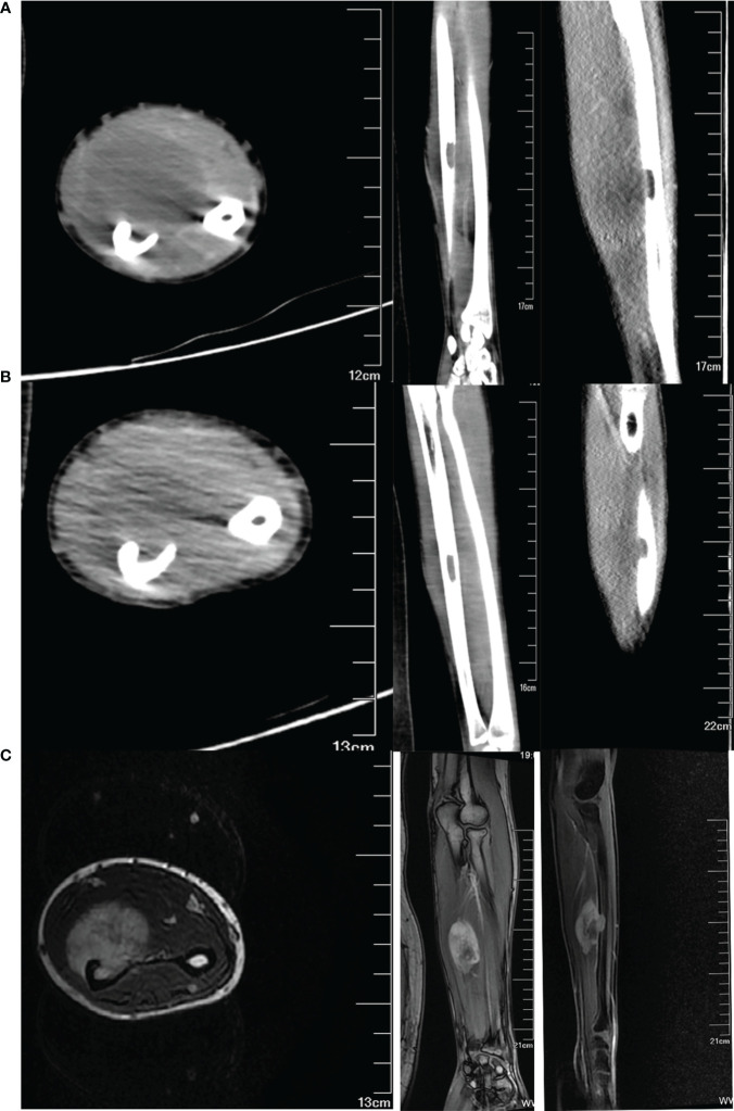 TAC y resonancia de un rabdomiosarcoma alveolar del antebrazo.