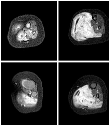 Rabdomiosarcoma embrionario de la pierna en RM