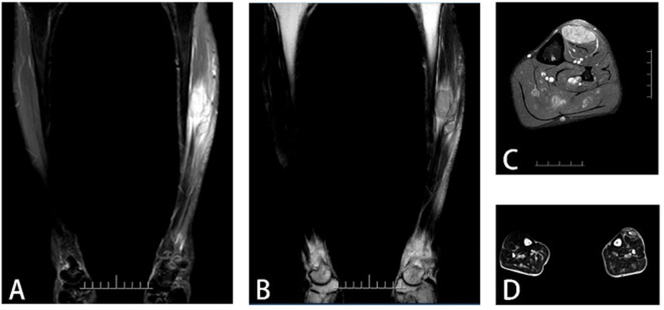 Resonancia de la pierna con un rabdomiosarcoma pleomórfico extenso y heterogéneo.