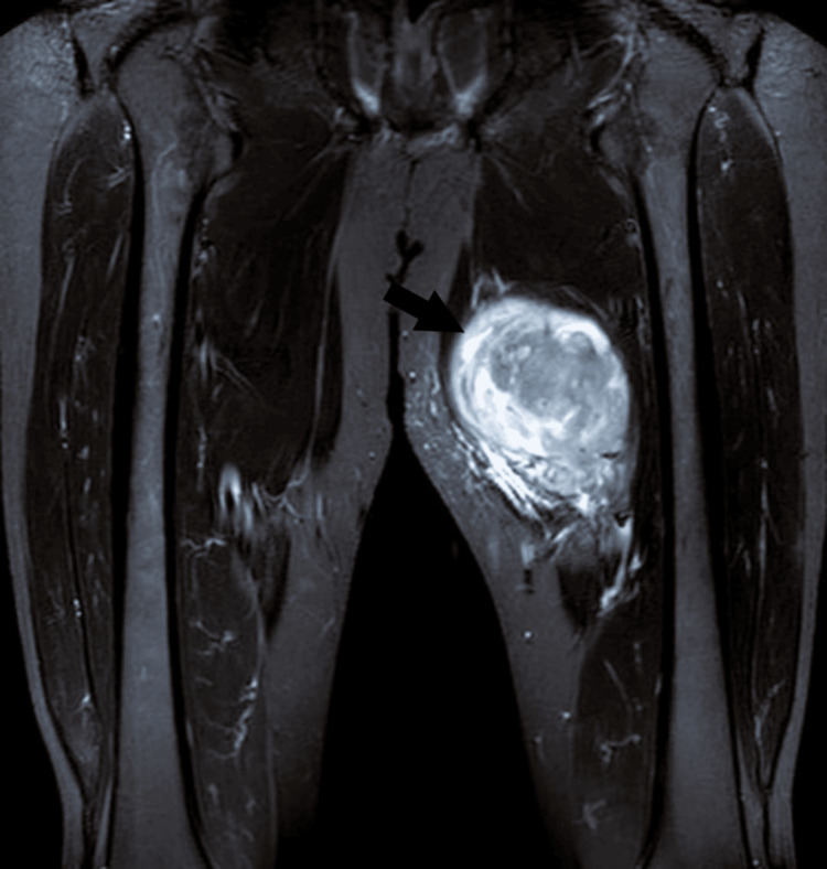 Sarcoma con alteración BCOR del muslo en RM