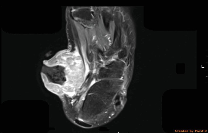 Resonancia de un sarcoma de células claras en el pie.