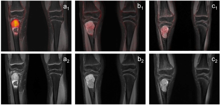 PET/MRI y RM de un sarcoma de Ewing en la tibia proximal derecha, antes y durante el tratamiento.