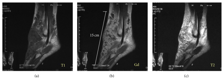 Sarcoma fibroblástico mixoinflamatorio del tobillo en RM