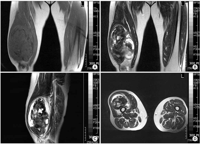 Sarcoma fibromixoide de bajo grado del muslo en RM