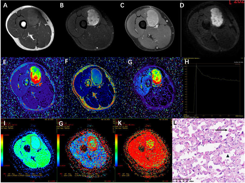 Resonancia de un sarcoma alveolar de partes blandas en el muslo derecho.