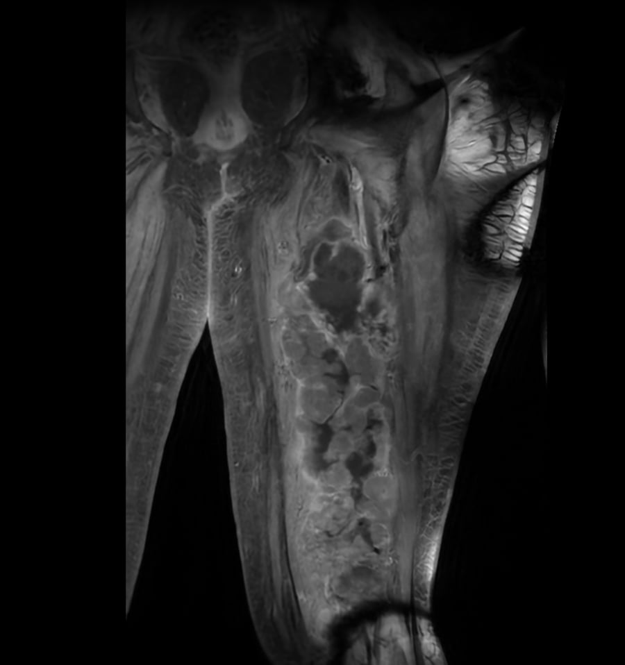 Resonancia coronal de muslo con sarcoma pleomórfico indiferenciado: masa multilobulada de partes blandas.