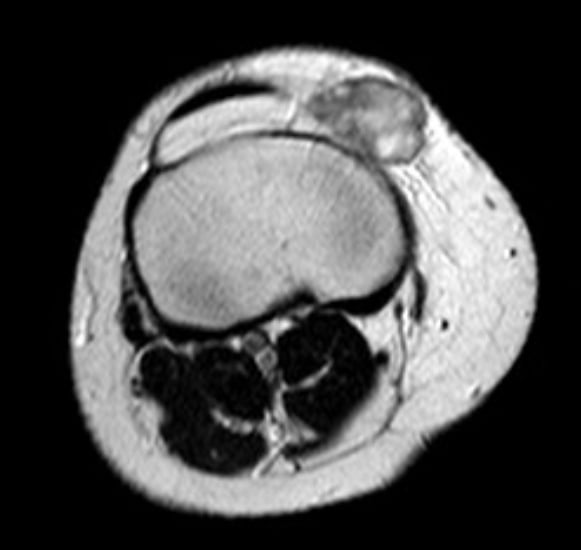 Resonancia axial en T1 de la pierna proximal, en la cara anteromedial de la tibia, con un sarcoma pleomórfico indiferenciado: masa de partes blandas heterogénea y bien delimitada.