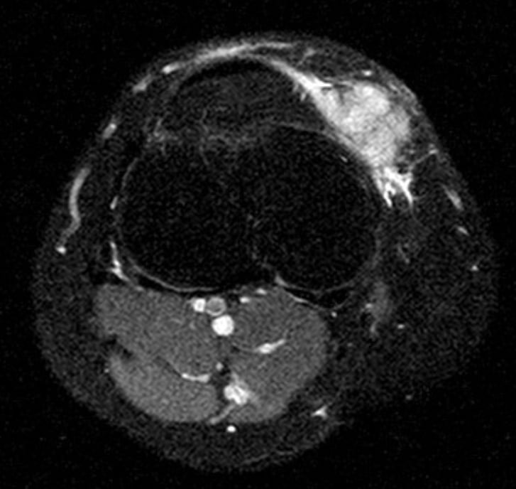 Resonancia axial con supresión grasa de la misma lesión de la pierna proximal (cara anteromedial de la tibia): señal hiperintensa heterogénea del sarcoma pleomórfico indiferenciado.