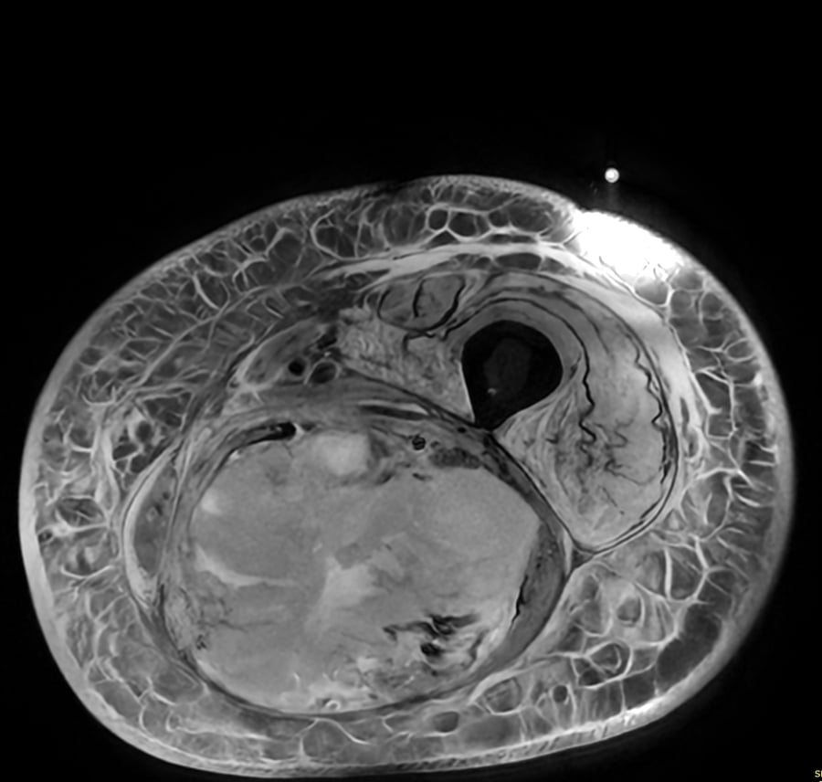 Resonancia axial de muslo con sarcoma pleomórfico indiferenciado: masa intramuscular heterogénea, bien delimitada.