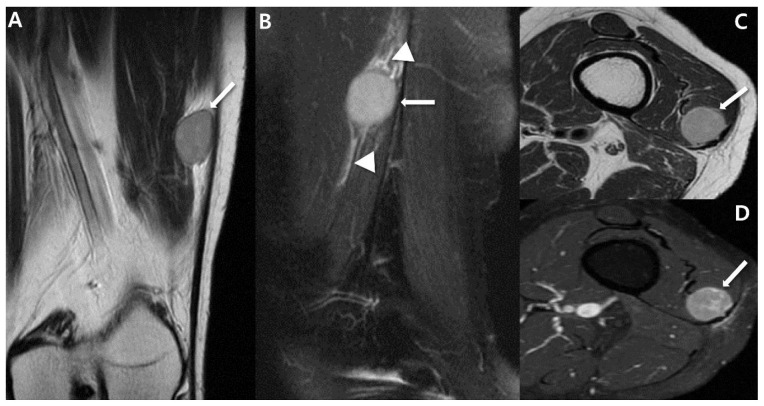 Resonancia de un sarcoma sinovial de muslo, como masa profunda bien delimitada.