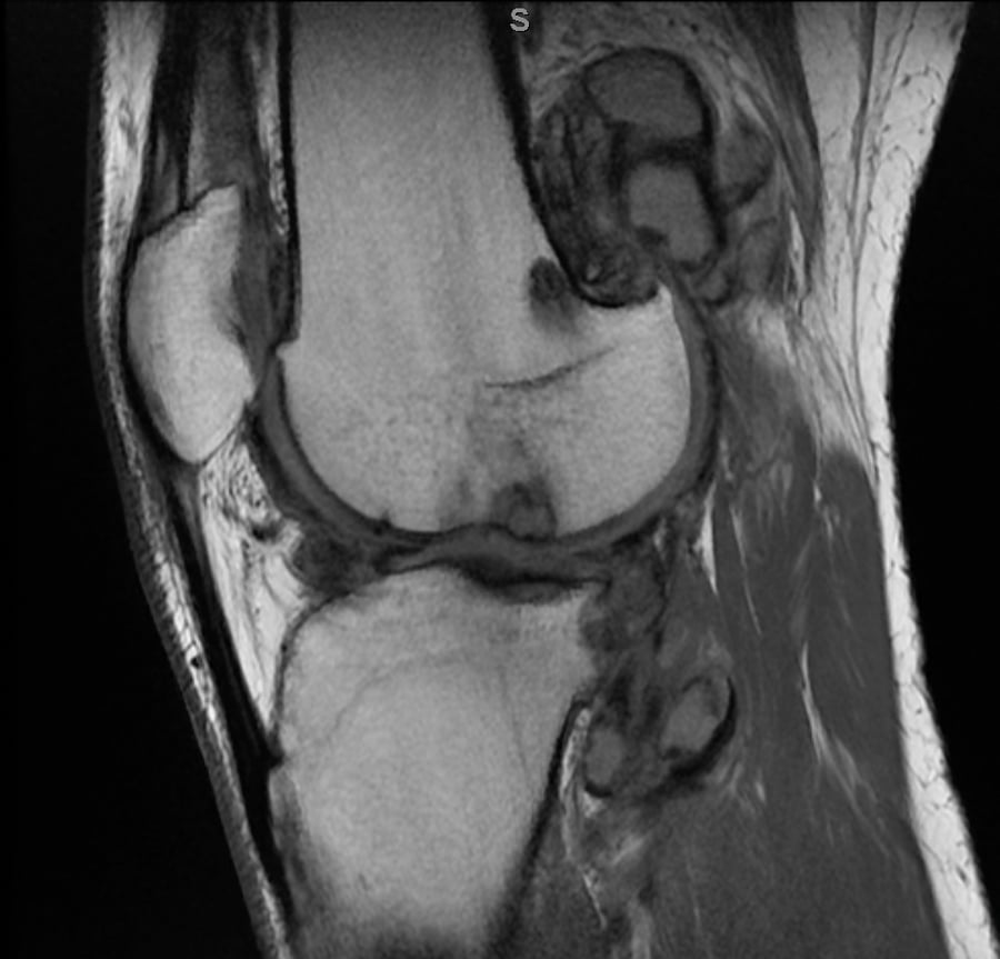 Resonancia sagital de rodilla del mismo caso de TGCT difuso, con masas sinoviales nodulares hipointensas.