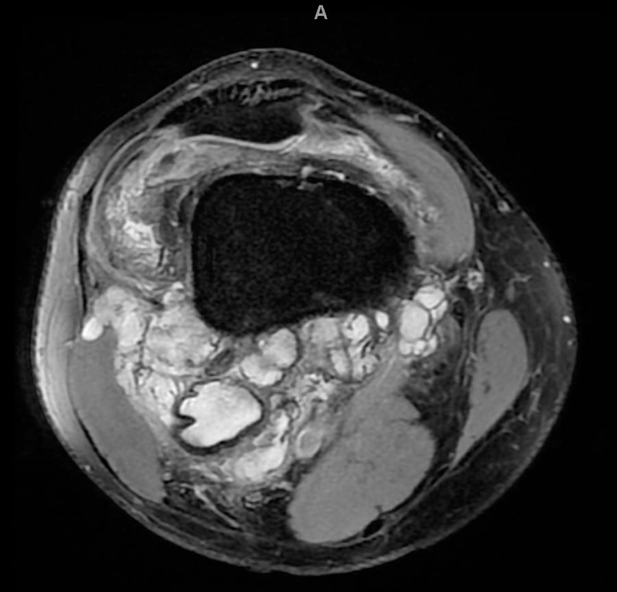 Resonancia axial de rodilla con TGCT difuso: derrame articular y proliferación sinovial nodular heterogénea.