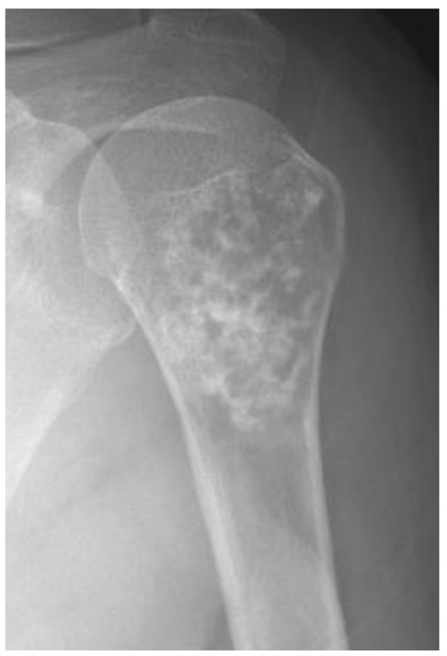 Radiografía de hombro de un tumor cartilaginoso atípico del húmero.