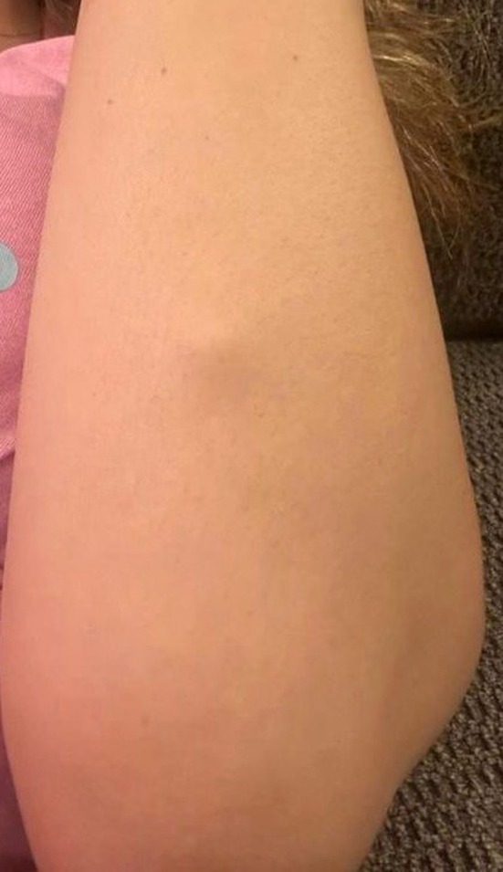 Fotografía clínica del antebrazo con un tumor de células gigantes de partes blandas