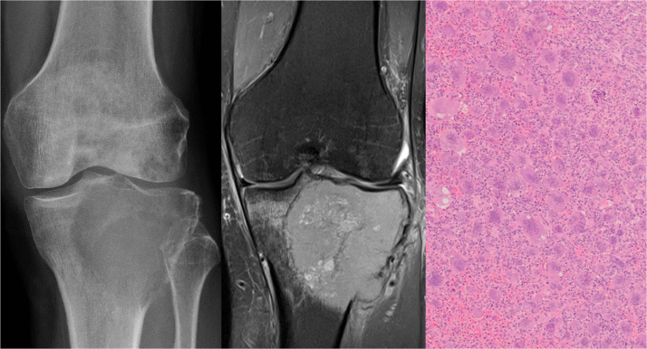 Radiografía, resonancia e histología de tumor de células gigantes tibial.