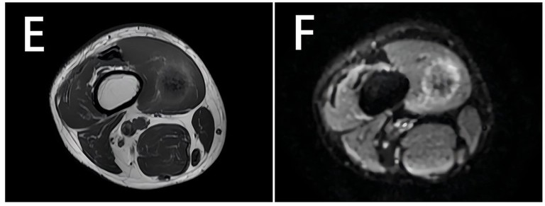 Tumor de células granulares intramuscular del muslo en RM