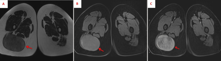 Tumor fibroblástico superficial CD34 positivo de la región glútea en RM