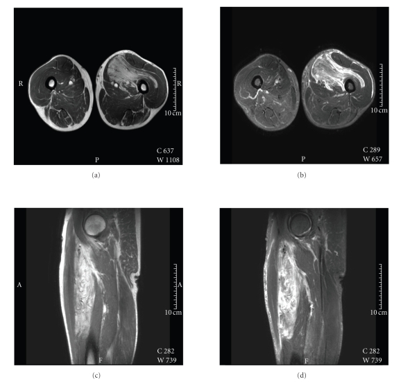 RM del muslo con un tumor fibrolipomatoso hemosiderótico.