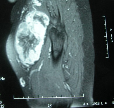 Tumor fibroso solitario del muslo en RM