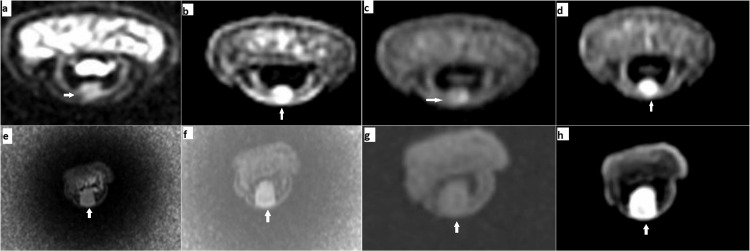 Resonancia de tumores glómicos en la falange distal de los dedos de la mano.