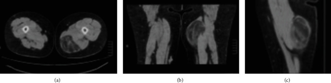 Tumor lipomatoso atípico del muslo en TC