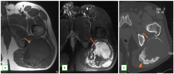 Resonancia y TAC de un tumor maligno de vaina nerviosa periférica del nervio ciático.
