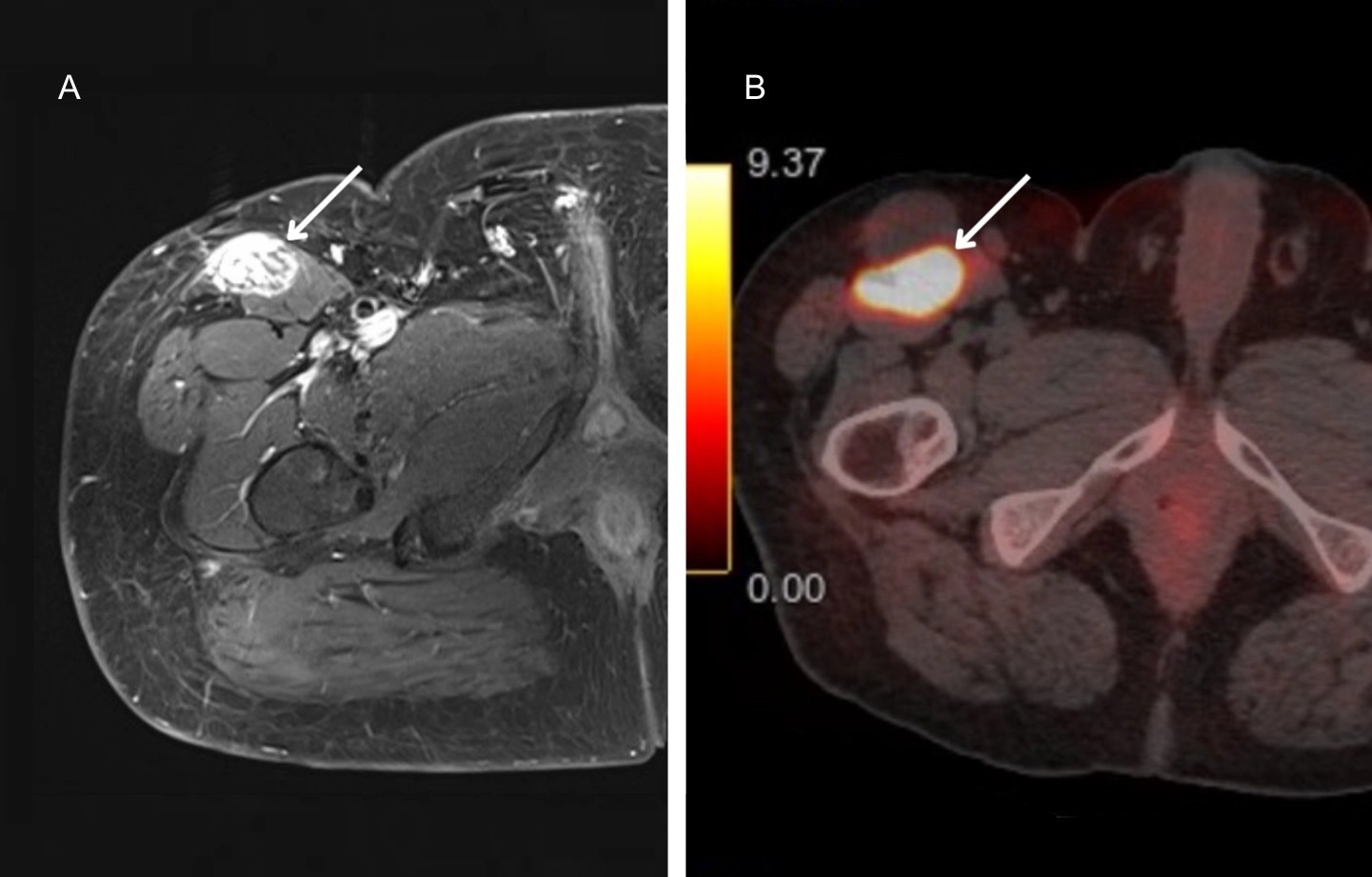 Tumor mesenquimático fosfatúrico del muslo en RM y PET/TC