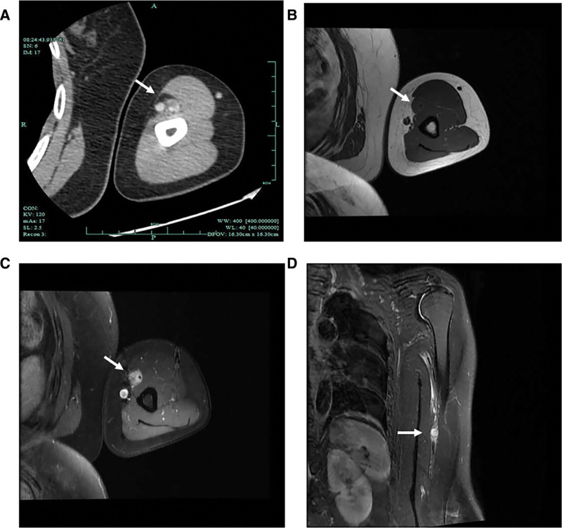 Tumor miofibroblástico inflamatorio del brazo en TC y RM